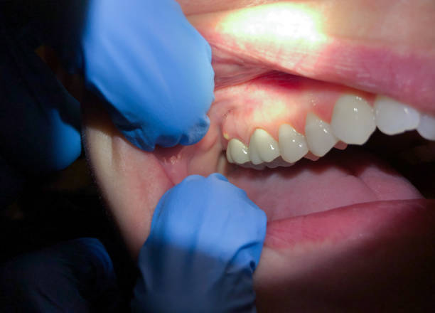 Best Emergency Tooth Extraction in Piney, AR